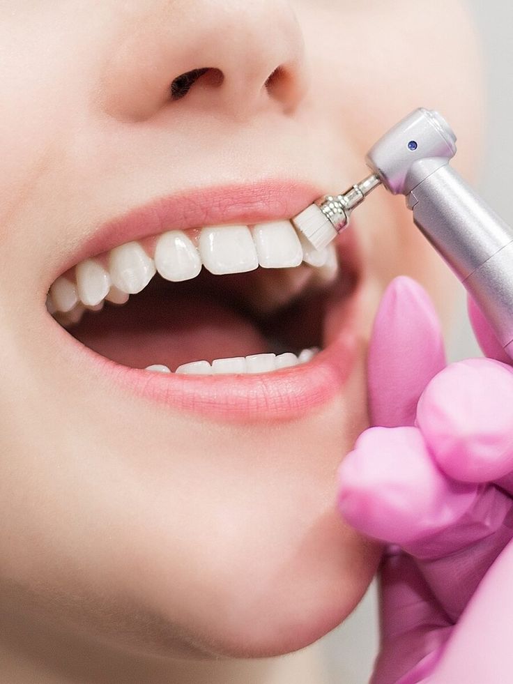 Teeth Whitening Treatment – Sanidhya Dental Rohini
